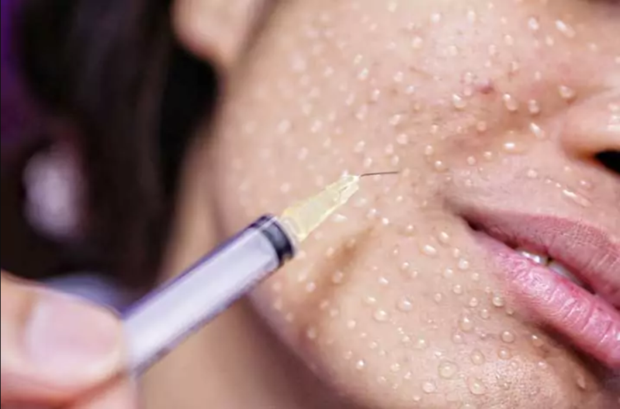 mesotherapie anti taches